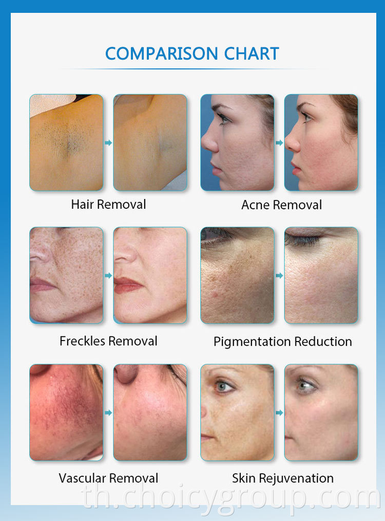 before and after ipl hair removal